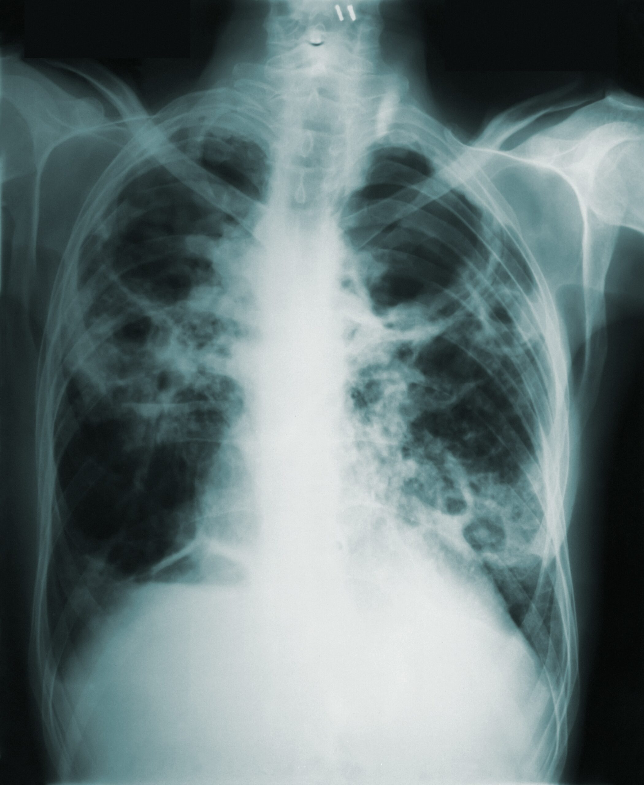 How EHRs Help Public Health Win the War Against TB
